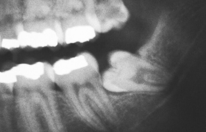 20 yaş dişi çekimi sonrası alveol bölgesinde pıhtı kaybı ve alveolit gelişimini gösteren bilgilendirici dental görsel.