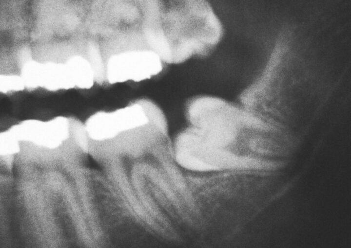 20 yaş dişi çekimi sonrası alveol bölgesinde pıhtı kaybı ve alveolit gelişimini gösteren bilgilendirici dental görsel.