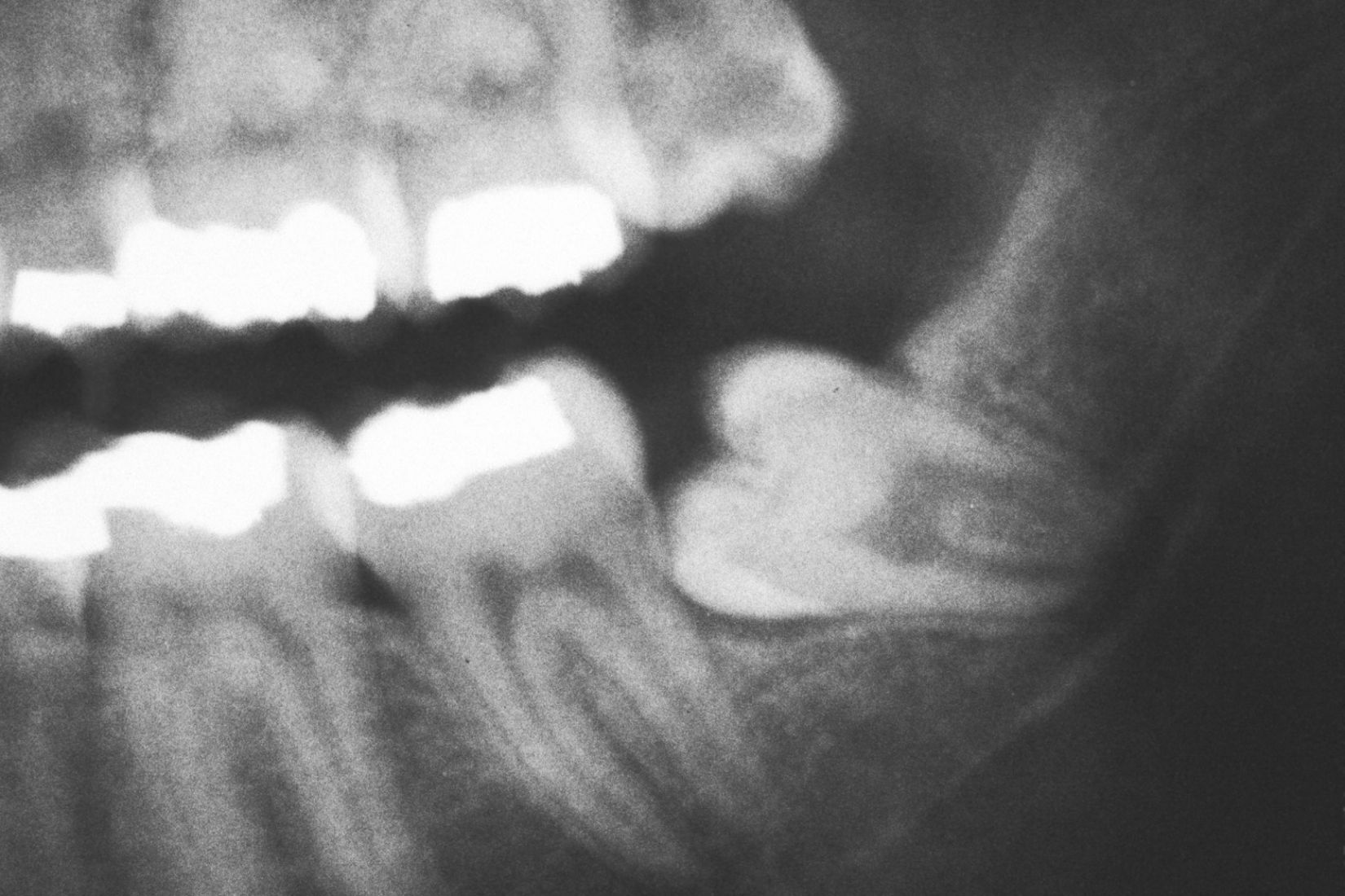 20 yaş dişi çekimi sonrası alveol bölgesinde pıhtı kaybı ve alveolit gelişimini gösteren bilgilendirici dental görsel.