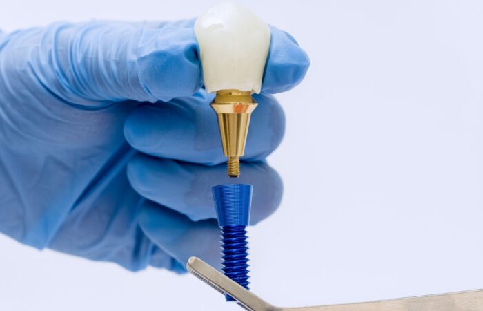 Dental implantın çene kemiğine yerleştirilmesi ve üzerine protez diş planlanmasını gösteren bilgilendirici görsel.