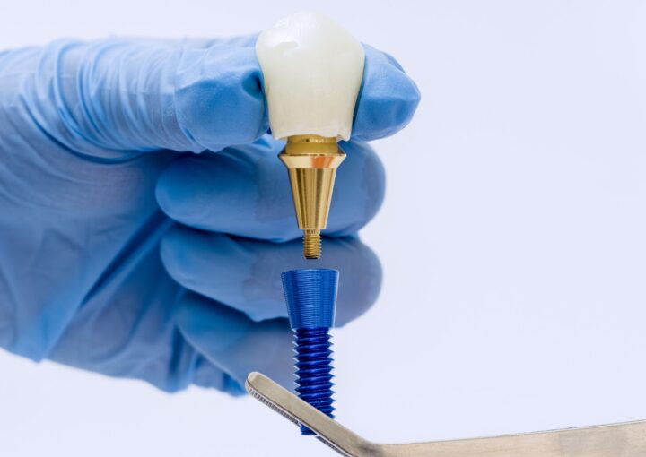 Dental implantın çene kemiğine yerleştirilmesi ve üzerine protez diş planlanmasını gösteren bilgilendirici görsel.
