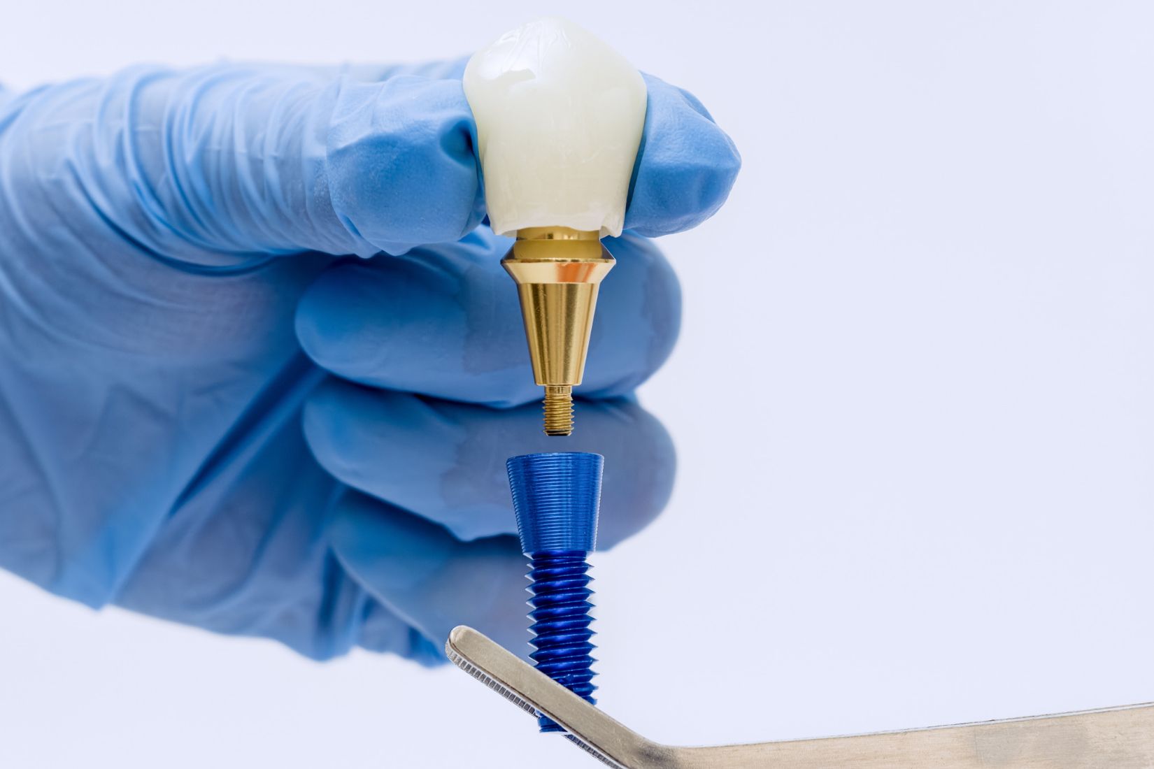 Dental implantın çene kemiğine yerleştirilmesi ve üzerine protez diş planlanmasını gösteren bilgilendirici görsel.