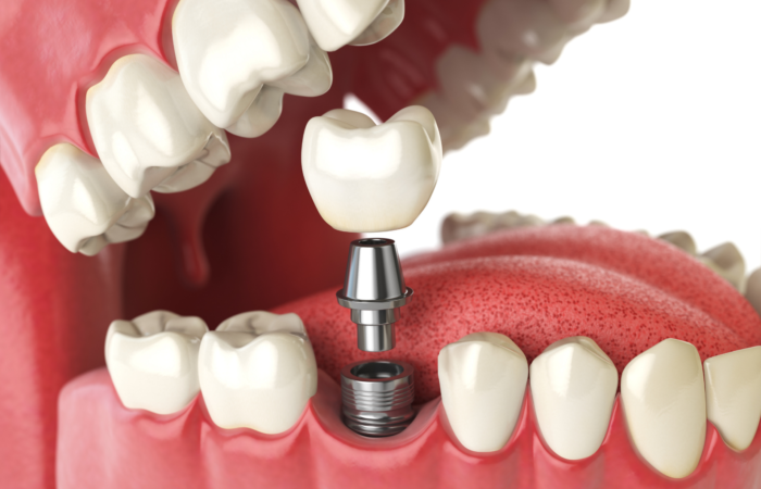 Dental implantın çene kemiğine yerleştirilmesi, osseointegrasyon süreci ve implant üstü protez aşamalarını gösteren görsel.