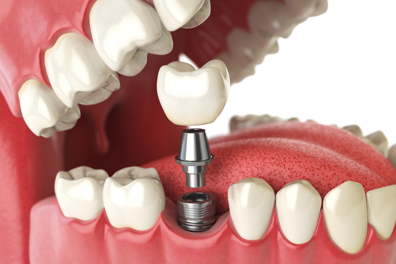 Dental implantın çene kemiğine yerleştirilmesi, osseointegrasyon süreci ve implant üstü protez aşamalarını gösteren görsel.