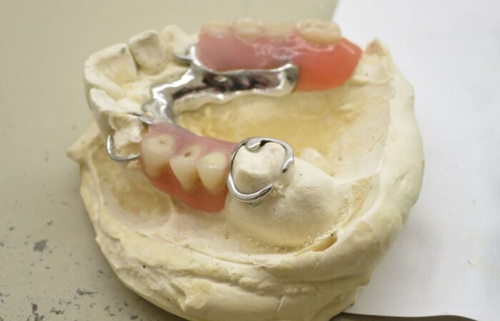 Eksik dişlerin yerine kullanılan kancalı hareketli bölümlü protezin dişler ve destek dokularla ilişkisini gösteren dental görsel.