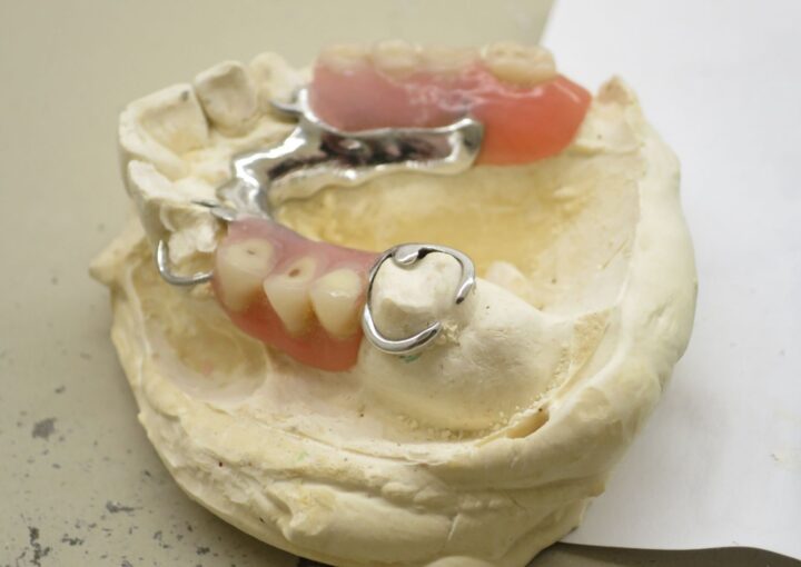 Eksik dişlerin yerine kullanılan kancalı hareketli bölümlü protezin dişler ve destek dokularla ilişkisini gösteren dental görsel.