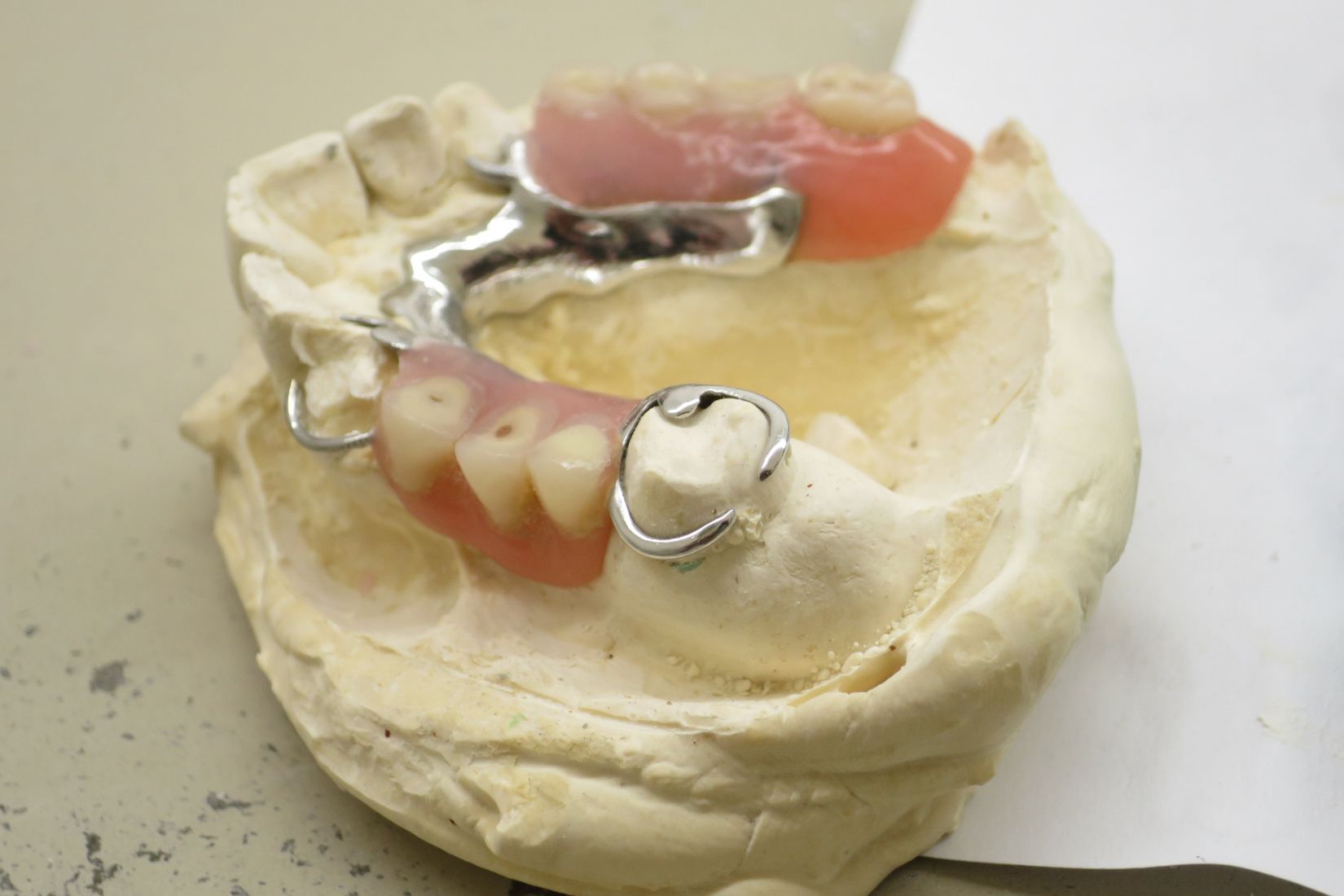 Eksik dişlerin yerine kullanılan kancalı hareketli bölümlü protezin dişler ve destek dokularla ilişkisini gösteren dental görsel.